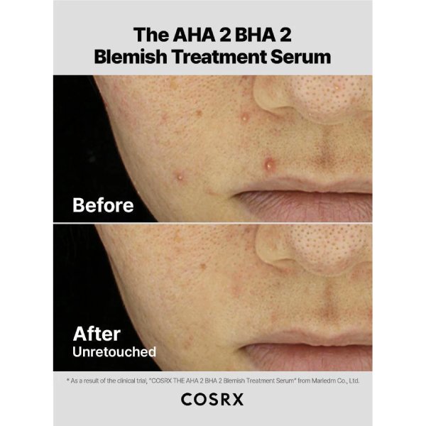 cosrx the aha 2 bha 2 blemish treatment serum befor after سرم و پد ضدجوش AHA و BHA کوزارکس تاثیر
